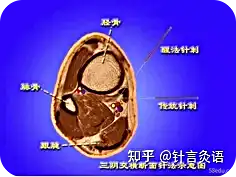 石学敏教授针灸系列视频图解2